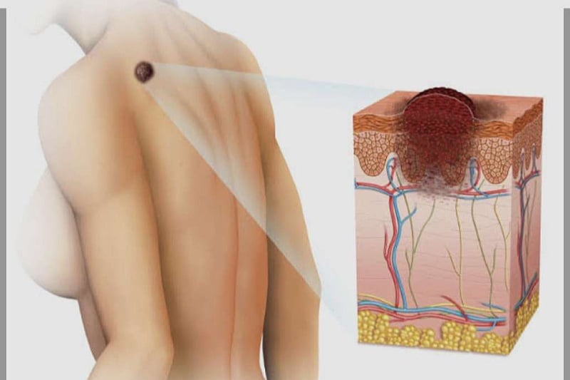 U FBiH godišnje se dijagnosticira oko 250 novih slučajeva melanoma: Uz ABCDE pravilo prepoznajte promjene