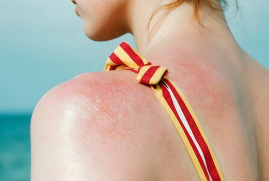 Znate li šta je solarna urtikarija?